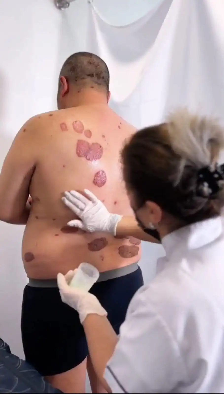 аппликации с нафталаном против псориаз и экземы