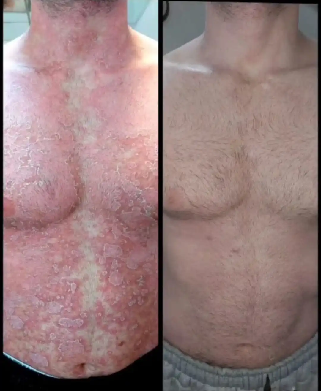 Лечение псориаза Нафталаном до и после